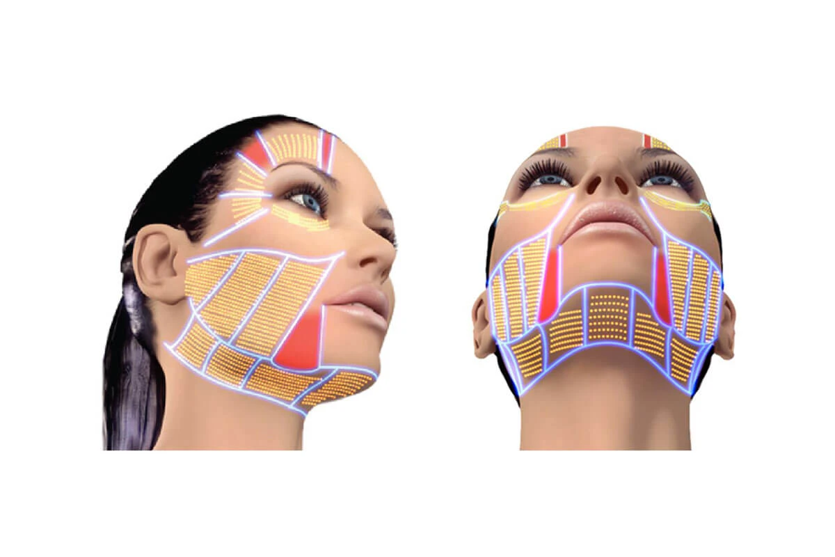 hifu urządzenie super-lift mini hifu smas lifting