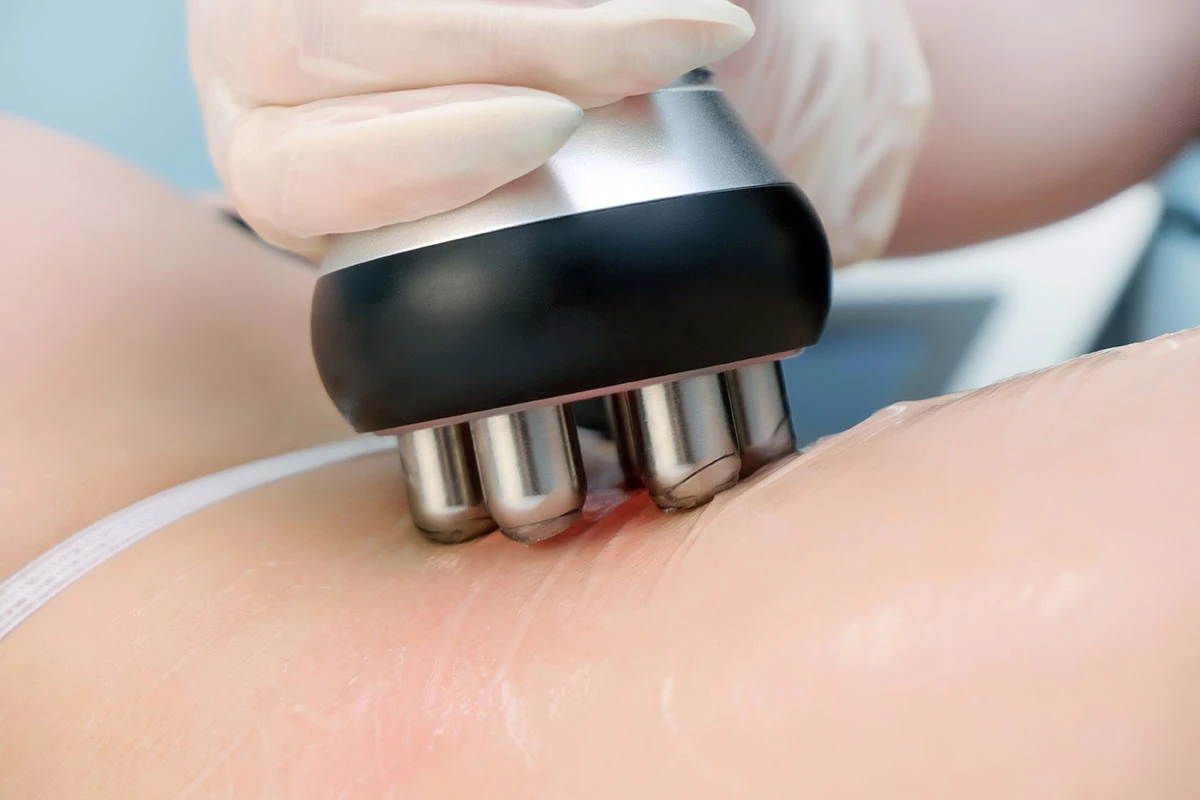 jak skutecznie prezentować zabieg rf-liftingu klientom