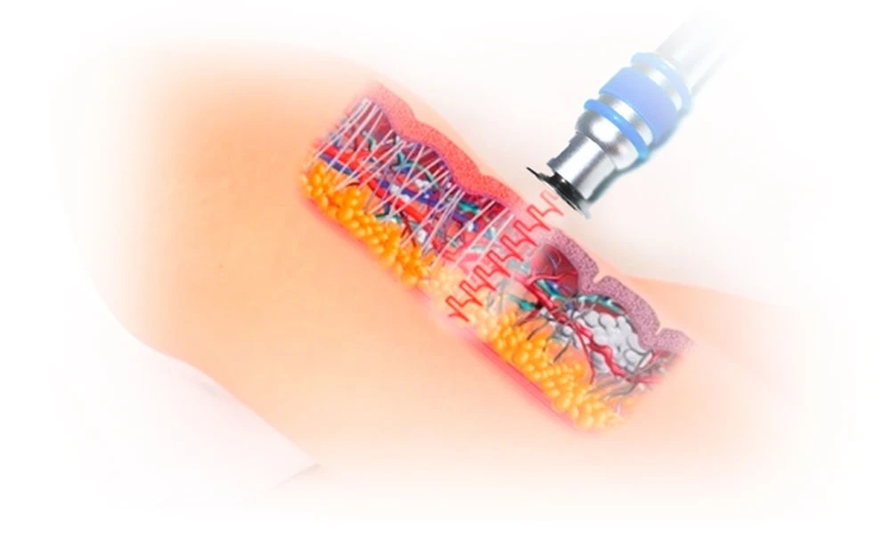 Jak przeprowadza się terapię falą uderzeniową